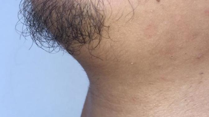 Sakalım henüz düzgün çıkmıyor sizce çenemdeki bu sakalı bırakayım mı keseyim mi?