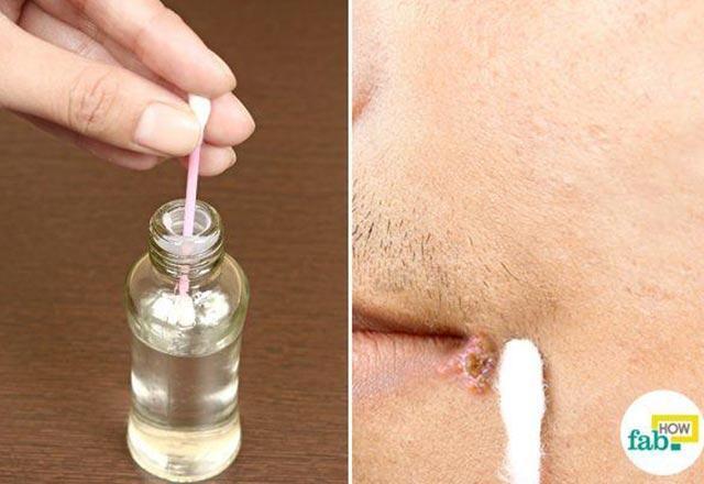 Dudakta Çıkan Uçuklara Ne İyi Gelir? Uçuk Nasıl Geçer?
