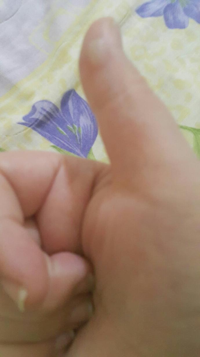Arkadaşlar elimi çakmakla yaktım şişti napim?