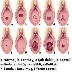 Ben bakireyim. aynadan vajinaya baktım ve ıkındım delik görünüyor ve büyük bir delik. bu normal mi boyle buyuk mu olur?