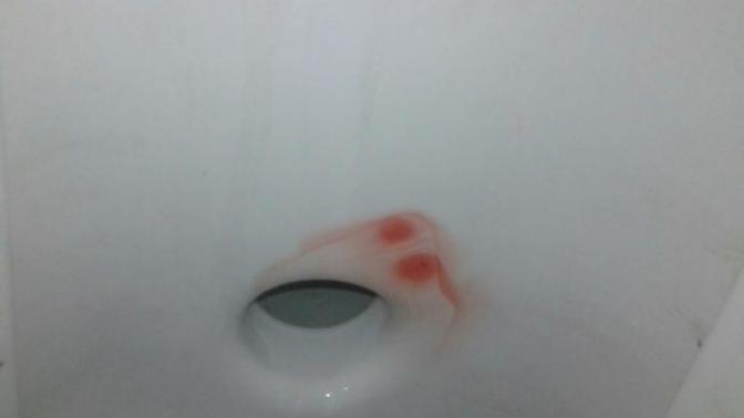 Arkadaşlar büyük tuvaletimi yaparken kan çıkıyor bakar mısınız?