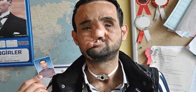 Sevgiliniz yüz felci olsa, onunla görüşmeye devam eder misiniz, yoksa uzaklaşır ve hayatınızdan mı silersiniz?