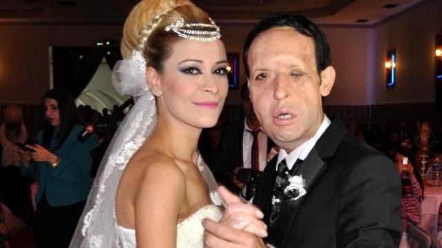 Sevgiliniz yüz felci olsa, onunla görüşmeye devam eder misiniz, yoksa uzaklaşır ve hayatınızdan mı silersiniz?