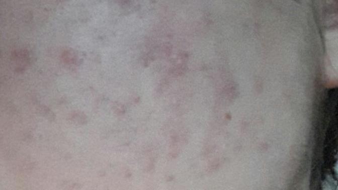 Roaccutane kullanmalı mıyım?