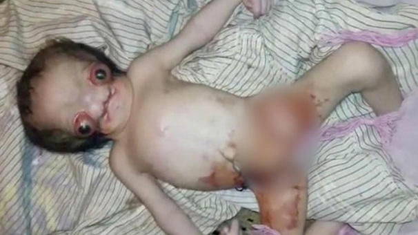 Hindistan'da doğan "Uzaylı Bebek"görenleri şoke etti. Böyle bir evladınız olsa onu dışlar mısınız?