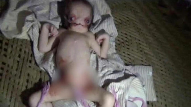 Hindistan'da doğan "Uzaylı Bebek"görenleri şoke etti. Böyle bir evladınız olsa onu dışlar mısınız?