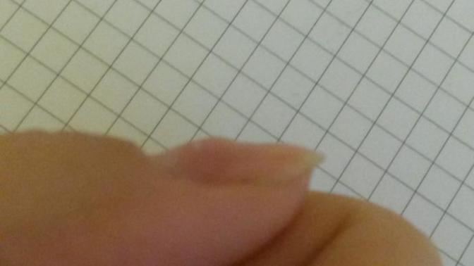 Baş parmağımın tırnağı içine göçük durumda ve gocen kısma dokununca acıyor?