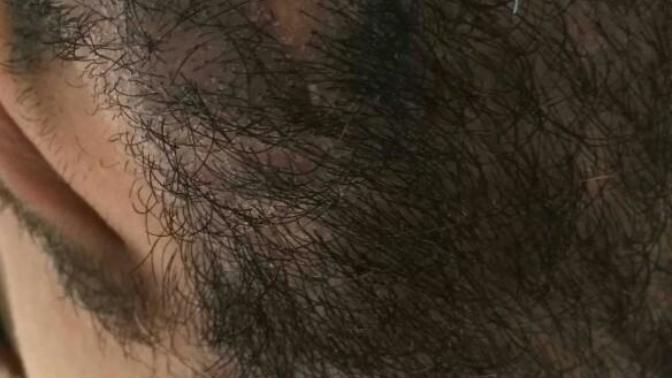 Yarılıp dikilen yerde tekrar sakal çıkar mı?