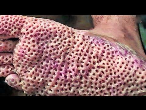 Tripofobi nedir?
