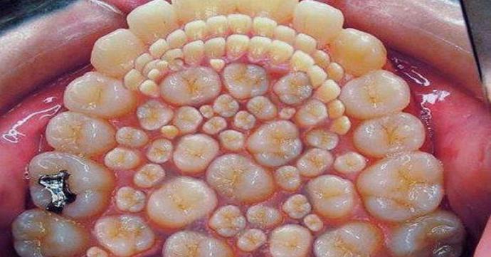 Tripofobi nedir?
