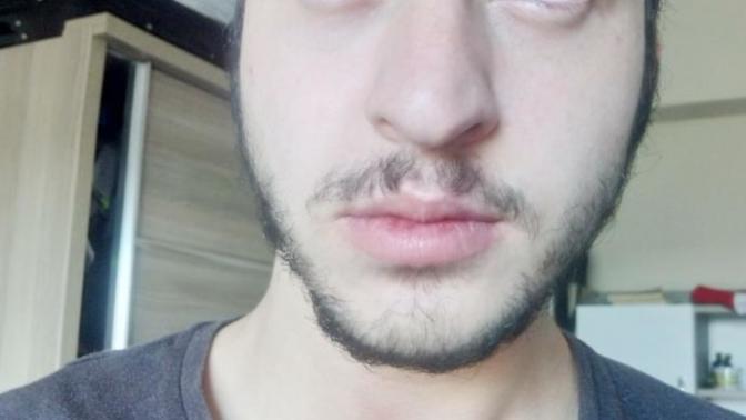 Tüyleri Nasıl Sakal Yapabilirim Çirkin Görüntüden Bıktım?