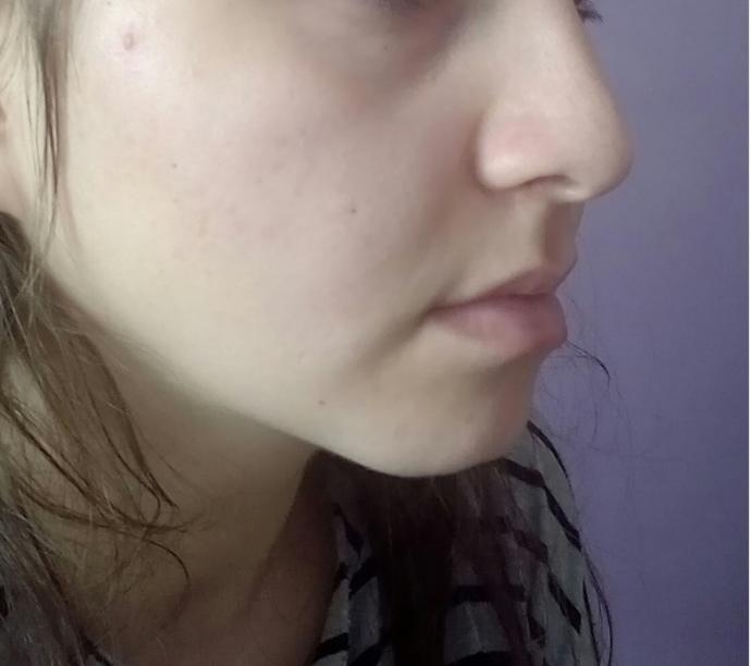 Çenem ve burnum çok kötü çok şekilsiz duruyor. Sizce hangi işlemleri yaptırmalıyım?