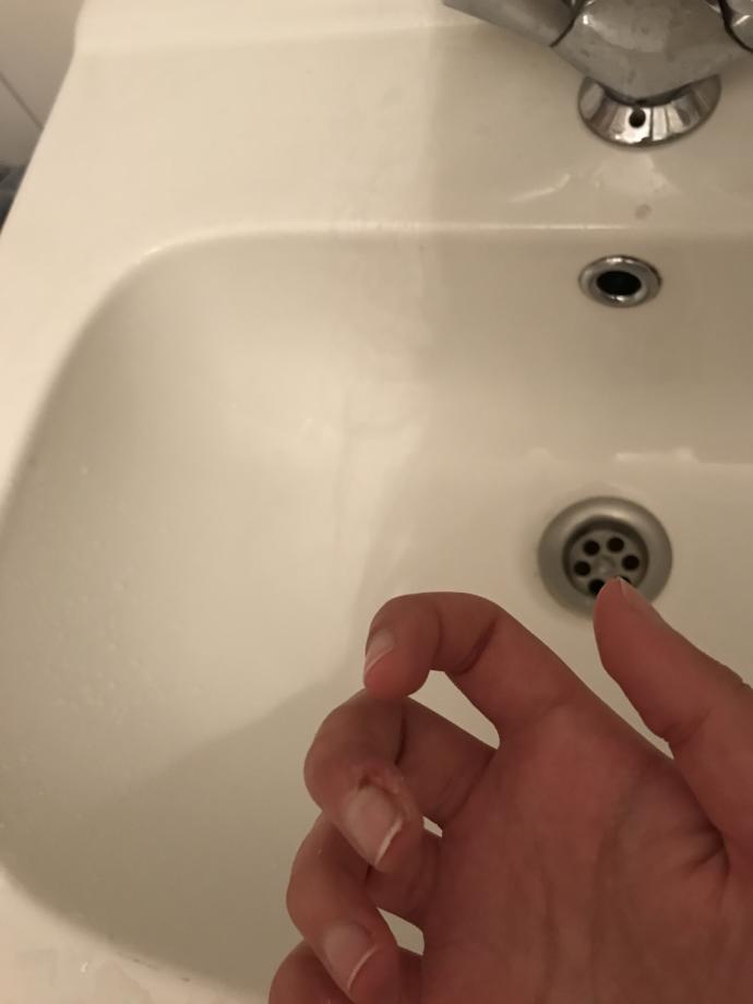 Parmagimi kestim ne yapmam gerek?