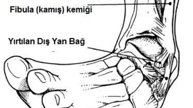 Ayağımı düz zemin üzerinde serçe parmağımın üzerine doğru burktum ve çat sesi geldi sizce çatlamış veya kırılmış olabilir mi?