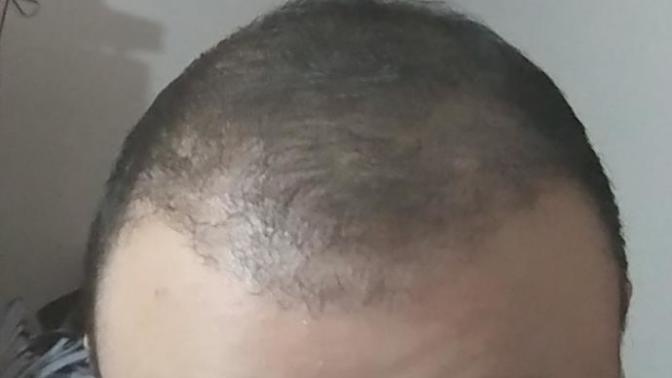 4 ay önce saç ektirdim bakar mısınız?