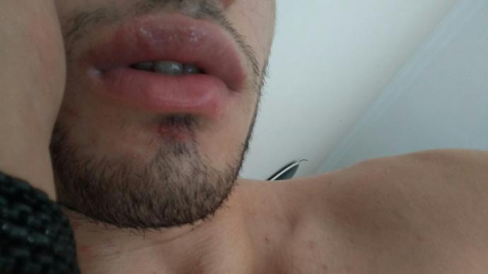 Dudağım kızın biriyle öpüştükten sonra böyle oldu krem sürdüm daha geçmedi sebebi ne olabilir sizce?