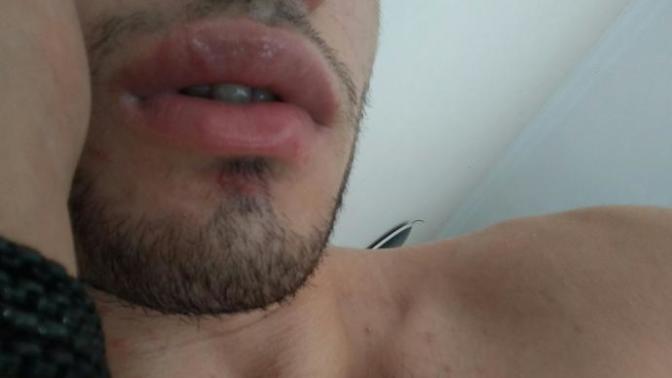 Dudağım kızın biriyle öpüştükten sonra böyle oldu krem sürdüm daha geçmedi sebebi ne olabilir sizce?