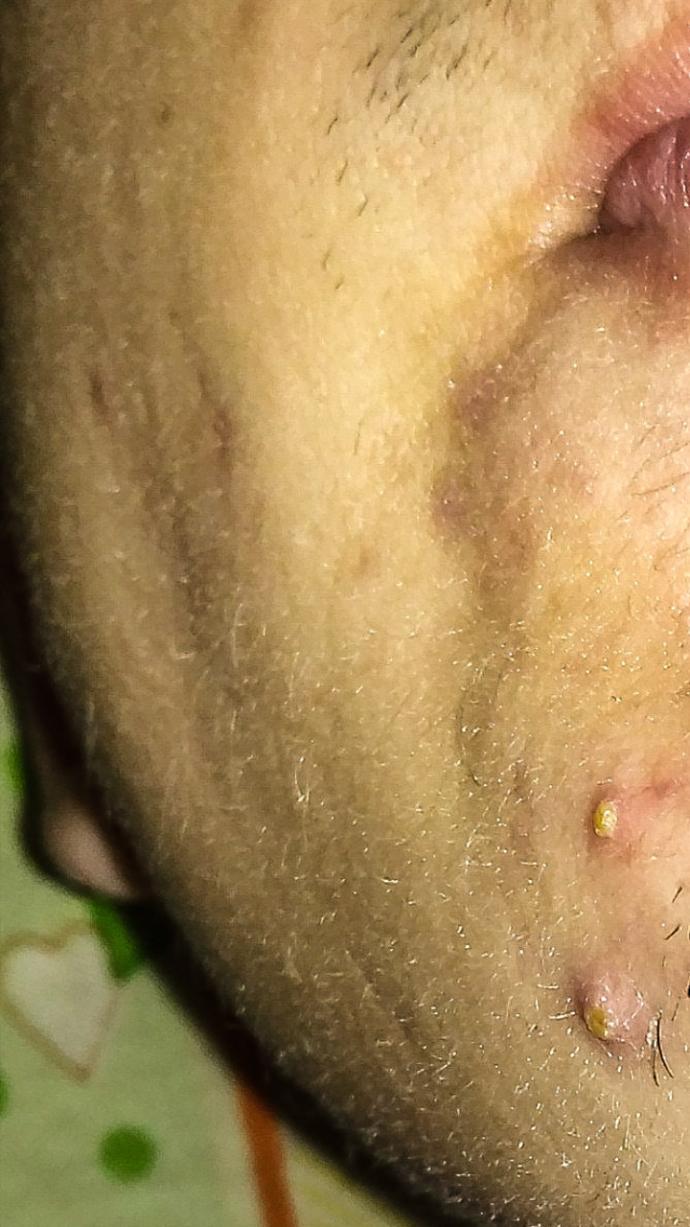 Acil bakın yas 19 yuzumde bu sene sakal olusumu basladi biraz gec ama sonunda sakalı olusturcak ince sari tuyler cikti detaya?