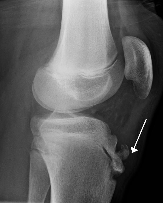 Osgood Schlatter hastalığı hakkında ?