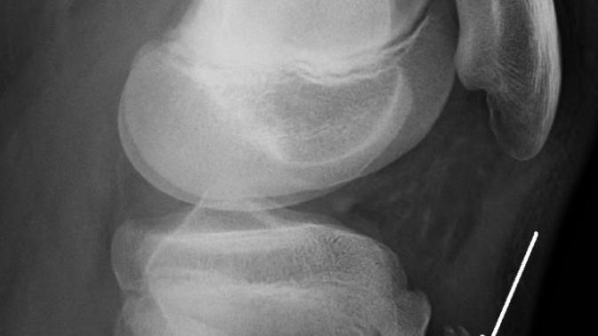 Osgood Schlatter hastalığı hakkında?