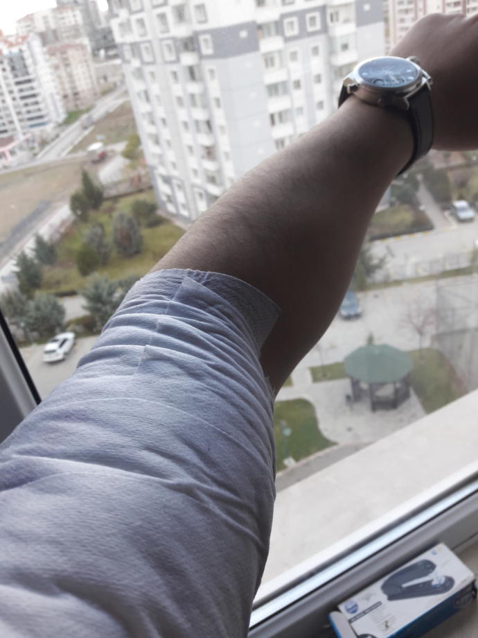 Epilasyon mu ağda mı?