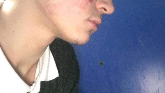 Roaccutane kullanımı?