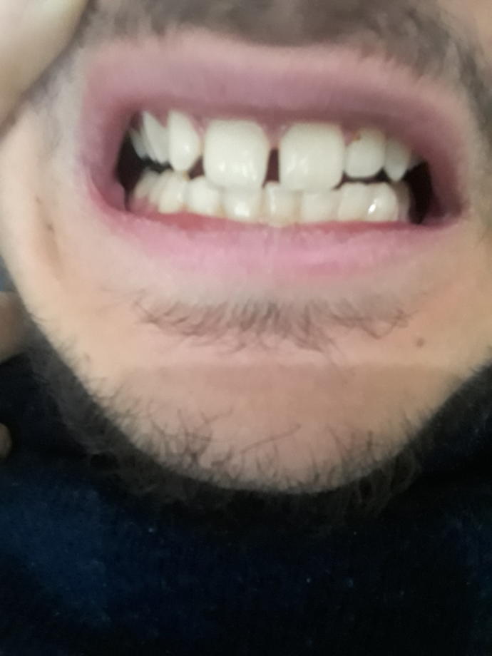 Sorum diş hekimlerine , ayrık dişlere hangi tedaviler uygulanabilir ?