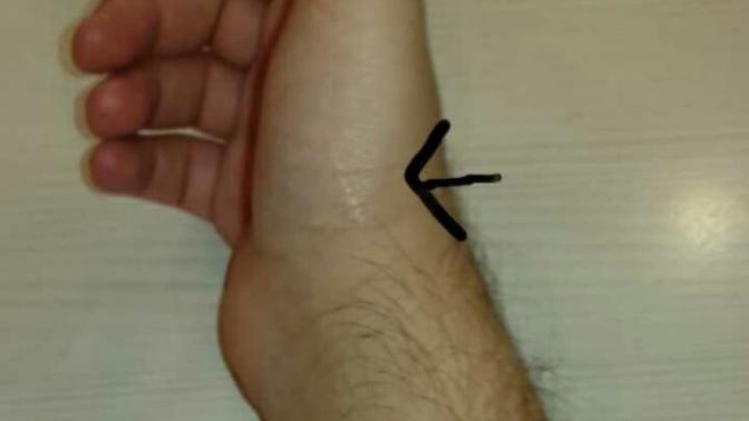 Sağ Elimde ve Avcumda Yara İzi Var Nasıl Geçer?