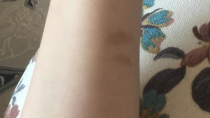 Kolumdaki yanık izi nasıl geçer?