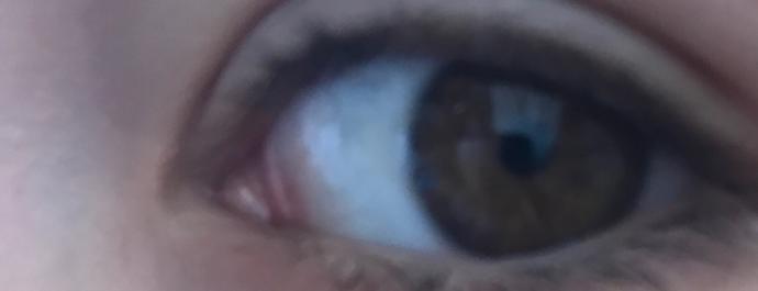Gözüm beyaz değil ne yapmalıyım👁?
