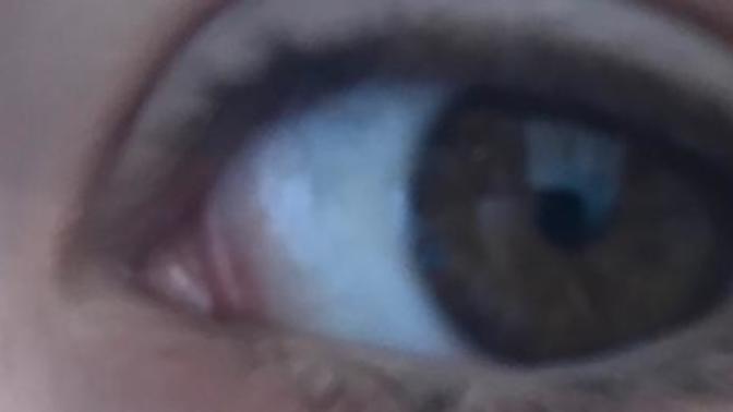 Gözüm beyaz değil ne yapmalıyım👁?