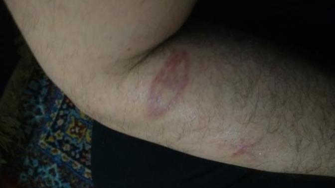 Dövme silim sonrası kirmizi yara oldu gecici mi?