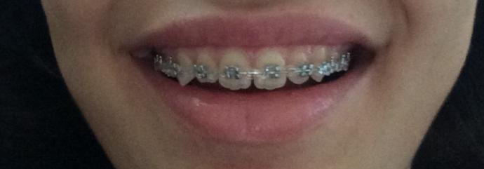 Braketimin üstündeki lastiği doktorum değiştirdi şu an bütün telde lastik var tedavinin sonlarına doğru mu böyle oluyo? (resimli)?