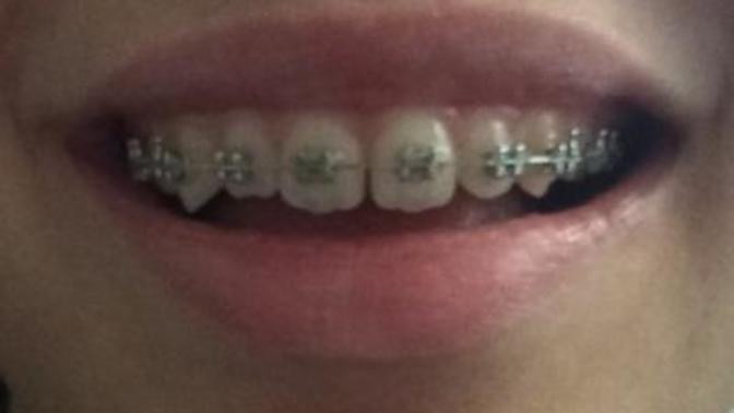 Braketimin üstündeki lastiği doktorum değiştirdi şu an bütün telde lastik var tedavinin sonlarına doğru mu böyle oluyo? (resimli)?