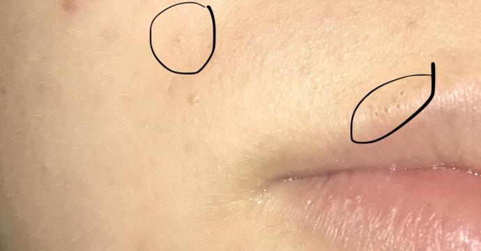 Siyah noktalarım ne yapıcam ben 😢😢😢?