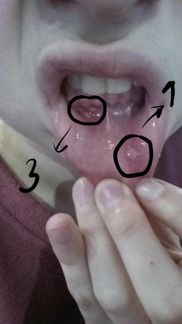 Anormal değil mi bu kadar iltihap çıkması ağzımda :'( ? 