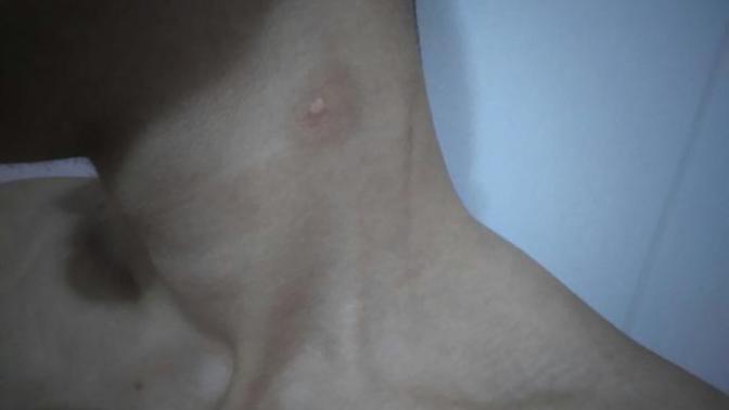 Boyunda ki morluk astsubaylık, PÖH, subaylık gibi şeylere engel midir?
