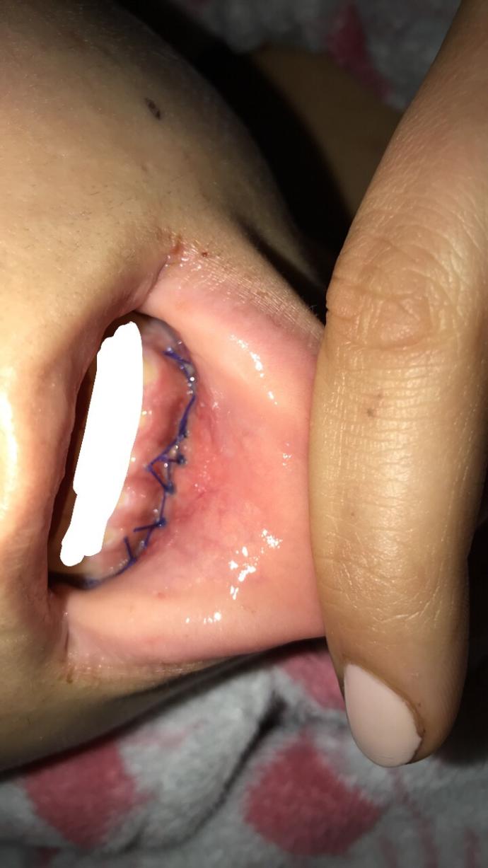 implant icin kemik yerlestirme ameliyati oldum?
