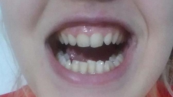 Zirkonyum/lamine kaplama düşünüyorum yaptıranlar bi̇lgi̇leri̇ni̇ paylaşabilir mi?