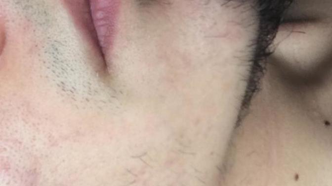 Sakal sorunu , sakallarımın daha gür ve düzenli çıkması için ne yapabilirim?