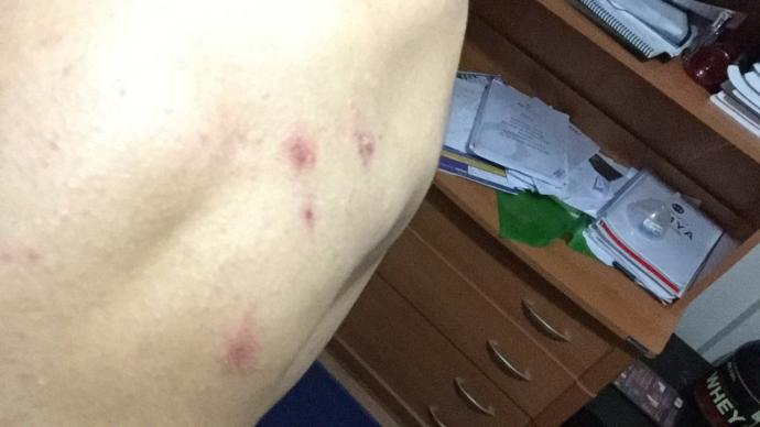Sirtimda ve karnimda yaralar cikti?