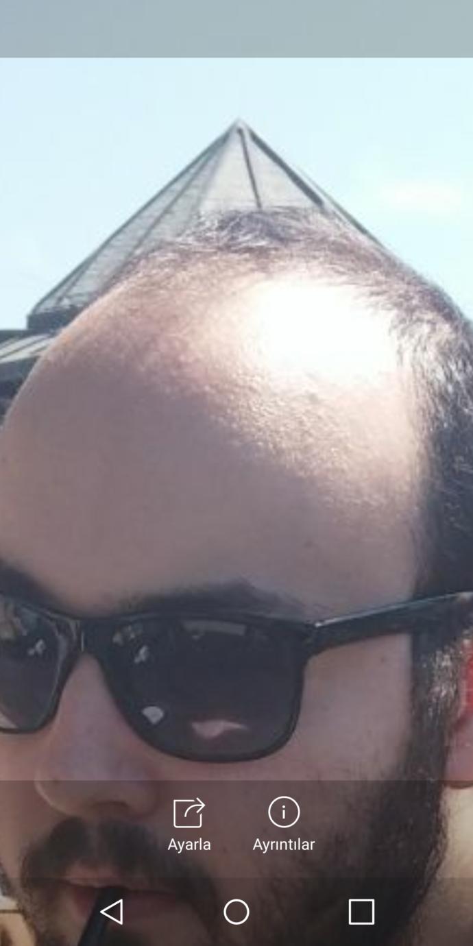 Saç ektirdim 6 ay önce durum nasıl?