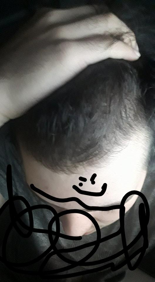 Saçlarım çok seyrek, acaba çok mu kafaya takıyorum bu durumu?