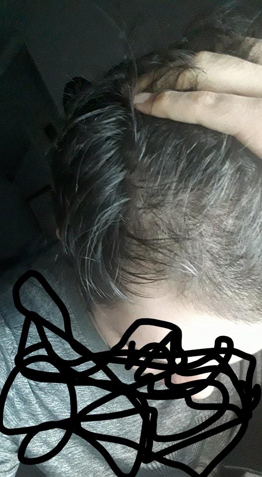 Saçlarım çok seyrek, acaba çok mu kafaya takıyorum bu durumu?