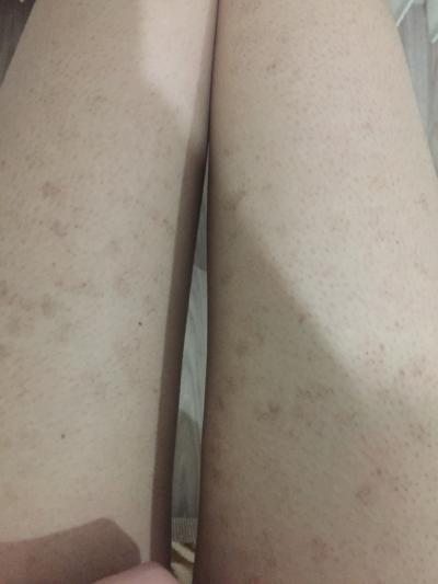 Lazer Sonrasi Bacagimda Lekeler Olustu Gecer Mi Kizlarsoruyor