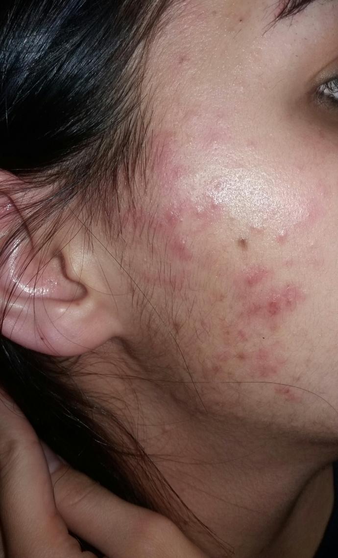 Lutfen yardim edin bu sivilceden akneden nasil kurtulurum midesi bulananlar bakmasin :(( ?