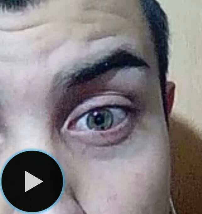 Göz kapağı şişmesi ? ? ??