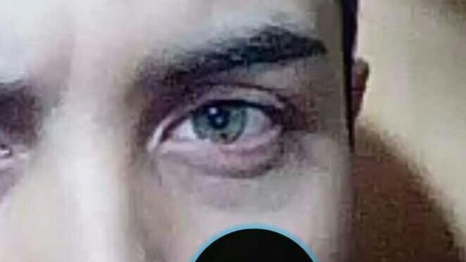 Göz kapağı şişmesi? ? ?