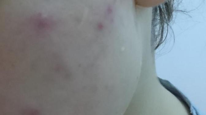 Yüzüme ağda yaptırdım şu an bu halde. Kadın da yağ sürdüğü için sanırım. Nasıl geçer (resimli)?