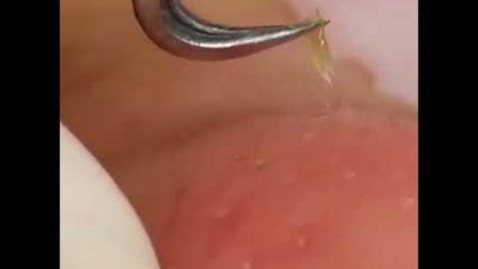 Siyah nokta temizleme videoları izliyor musunuz?